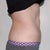 One month and two weeks after second treatment of abdomen (upper and lower)