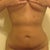 Day 5 post op- getting better