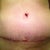 Wound 15 days PO