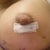 PO4- incision site