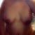 My two week post op picture front view