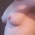 With Implants side view
