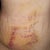 3 days post opp (worst of the brusing)