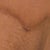 3 months, 1 day.  This part of the scar has stretched out and become dark.  It is the only place this has happened on my body.