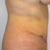 post op day 16 side