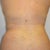 post op day 16 back