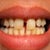 Beginning of Tray 3- without Invisalign