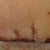 04/19/13-2 weeks-front scar close up-scabbing