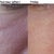 Fraxel II Progression