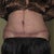 POD 12 Lower abdomen incision tape removed.  Looking good!