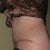 POD 12 Left side view.  Incision nice and low, even at hip.  Healing well.