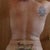 3 1/2 weeks post op,some swelling