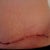 Tummy tuck side view 9 days post op