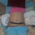 Post-Op Day 2. The black strip  is a wound vac. My PS uses those so incisions heal faster. I LOVED that thing!