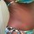Side of String Bikini.  It naturally fit in this place I did not adjust a thing.  Dr. Robles did incredible work with my incision.