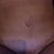 3 weeks post op