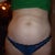 Tummy- front view 6 days pre op