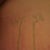 Stretch mark length