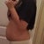 2 days before smart lipo