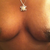 post op 21 days frontal view