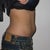 3 weeks post zeltiq