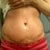 1 week post op incision