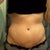 2 weeks post op incision