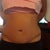 Two month post op!