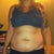 2 days pre-op. So embarrassing! Ugh. I could hide it well in jeans though. I know I won't be getting rid of the majority of stretch marks, but I will take what I can get.