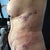 Day after surgery. Not as impressed with the side shot as the front one. Hoping that the bulging is just from swelling.