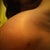 the incision on the square side L; implant is still high and hope it fills out!