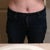 2 weeks - My pre op skinny jeans - no bulges!!!!! weird marks on my skin from CG and I do have a few stretch marks, no big deal :)