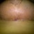 3 wks post op- Left breast underside. Healing really well.