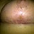 3 wks post op- Right breast underside. Healing a bit slower but getting there.