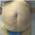 Before any procedures at all.  This was 2/15/2012.  Weight on this day was 174