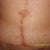 This is my abdomen, 9 month post op.