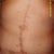 9 months post op. That thing in the center is my new bellybutton.