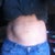 5 months post op
