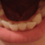 bottom teeth view :) - Tray#8