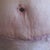 My scar 20 day PO.
