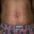the day before my surgery