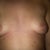 day before my surgery