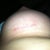 Incision on Day 30