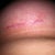 Right Breast Incision Day 30