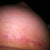 Left Breast Incision Day 30