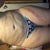 11days Post op