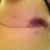 DAY OF POST OP - Crazy bruising. I have this on both sides