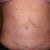 up close of my scar and belly button almost 4 months post op