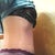side view. hipsters cover the scar so that is good.