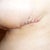 Incision on left side under arm where there is noticeable puckering.